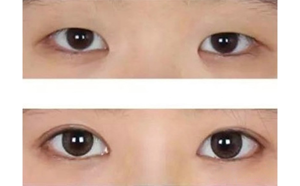 多大年紀適合做水泡眼矯正術?效果好不好?