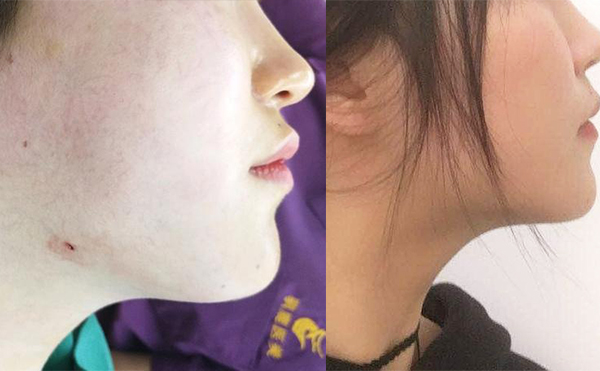 面部吸脂恢復(fù)期多長時間？