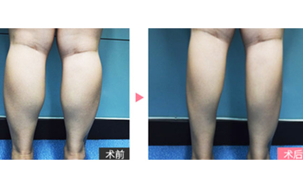 boxo瘦腿有什么優(yōu)勢？