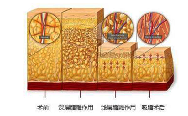 韓式分層吸脂的效果怎么樣？