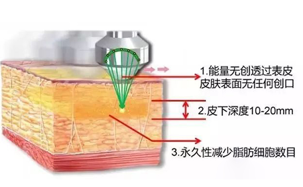 超聲波吸脂怎么瘦手臂？