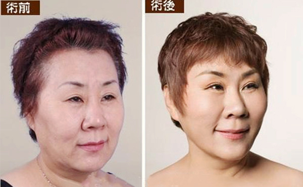 拉皮手術(shù)多久能恢復(fù)自然？