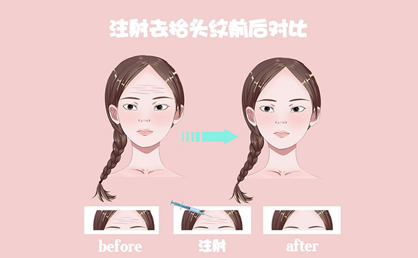 電波拉皮怎么去除抬頭紋？