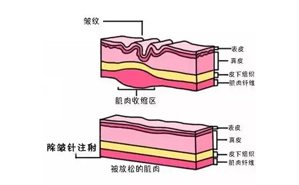 注射除皺是什么原理？