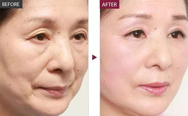 膠原蛋白除皺的適應(yīng)人群？