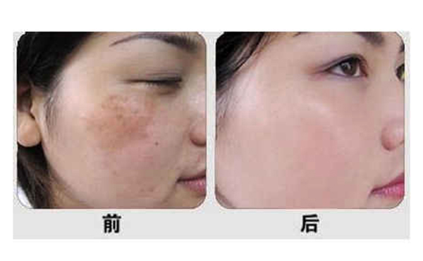 光子嫩膚有什么優(yōu)勢？