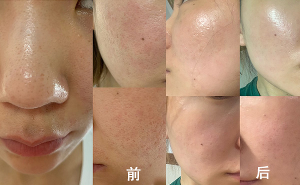 無針水光有什么優(yōu)勢？