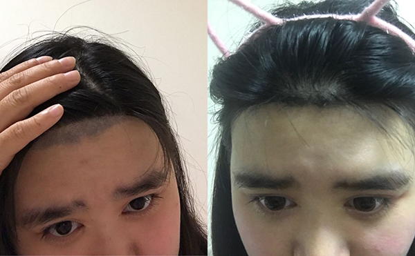激光脫毛安全嗎？