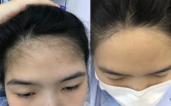 激光脫發(fā)際線的過程是什么？