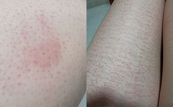 錯誤脫毛有什么后果？