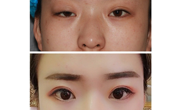 大小眼矯正多少錢(qián)?術(shù)后效果好不好?