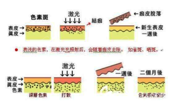 光子嫩膚和皮秒有什么區(qū)別？