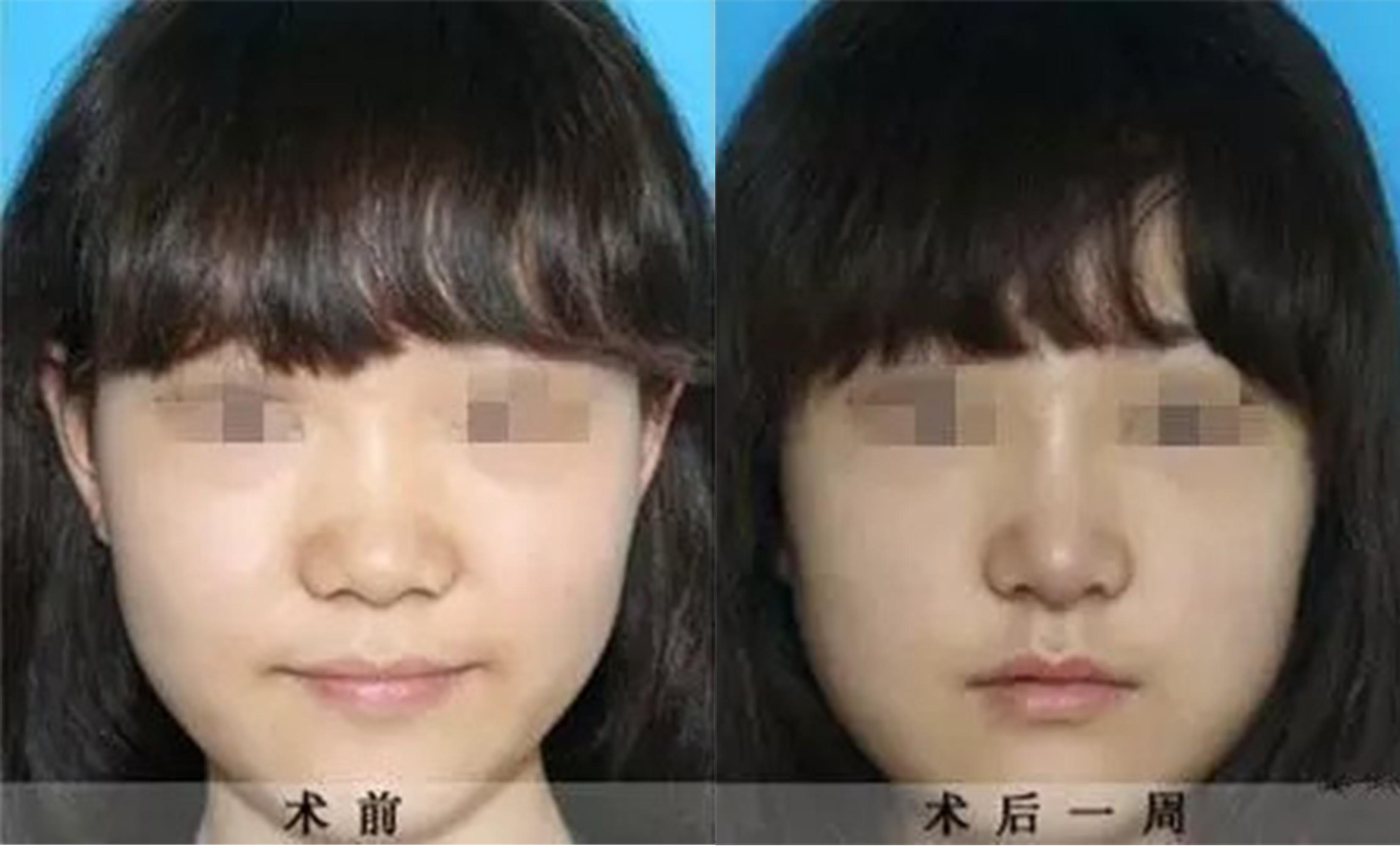 鼻頭、鼻翼縮小