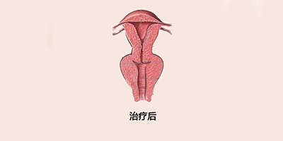 手術緊縮陰道術后