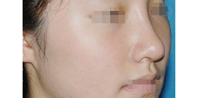 玻尿酸豐鼻基底術后