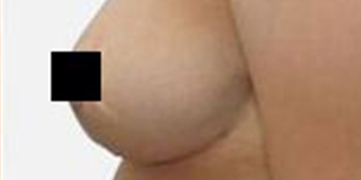 乳房下垂矯正術后
