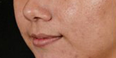 像素激光術前