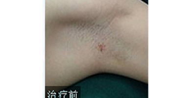 注射去狐臭術前