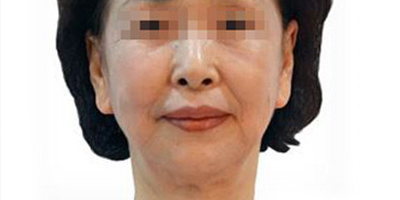 熱拉提術前