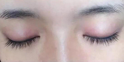 孕睫術術后