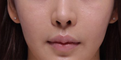 人中縮短術術后