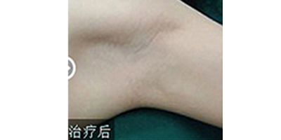 注射去狐臭術后