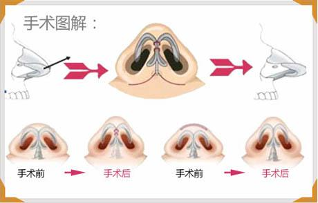 縮鼻頭手術(shù)可以保持多久？縮鼻頭手術(shù)術(shù)后注意事項？