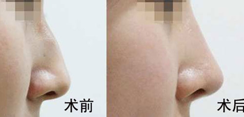 駝峰鼻矯正的方法有哪些？駝峰鼻矯正的方式及適合人群？