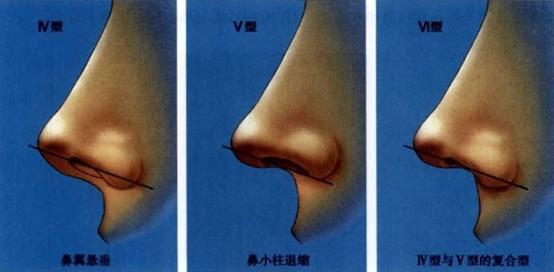 鼻小柱延長(zhǎng)術(shù)一般價(jià)位多少錢(qián)？做鼻小柱延長(zhǎng)術(shù)有什么不好的影響嗎？