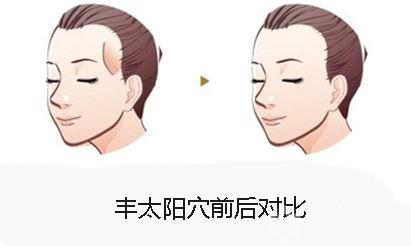 什么是自體脂肪豐太陽穴？用自體脂肪豐太陽穴的效果能維持多久？