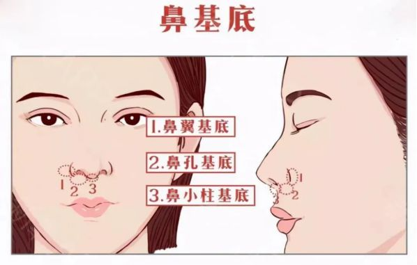 自體脂肪填充鼻基底好不好？鼻基底脂肪填充多久恢復(fù)？