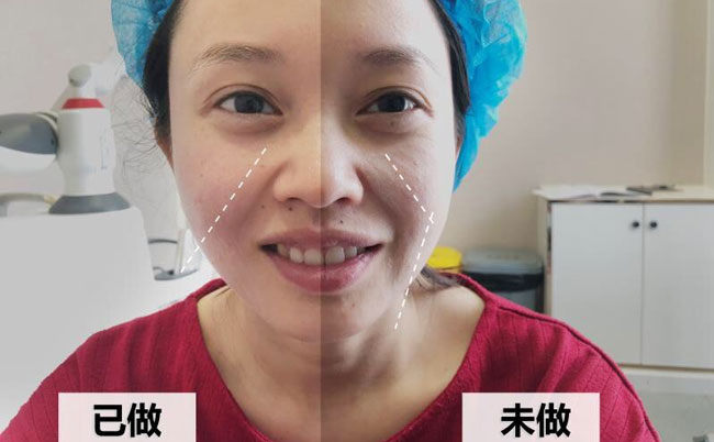 激光溶脂瘦臉的副作用及效果？光纖溶脂瘦臉多久可以見(jiàn)效？
