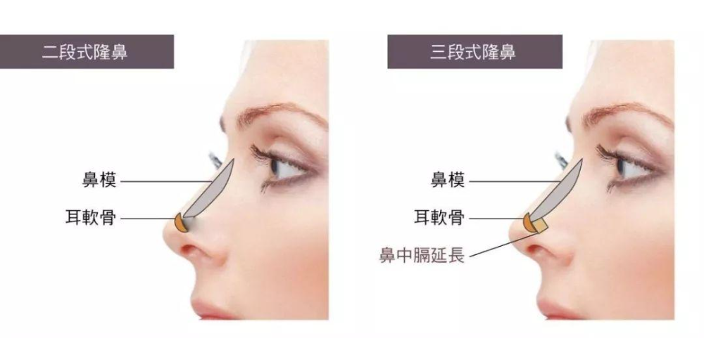自體軟骨隆鼻的手術優(yōu)缺點有哪些？肋軟骨填充鼻基底多久能自然？