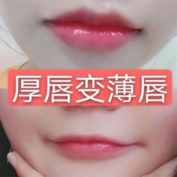 厚唇改薄整形手術價格？厚唇改薄多久完全恢復？