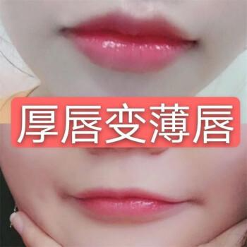 厚唇改薄整形手術(shù)價(jià)格？厚唇改薄多久完全恢復(fù)？