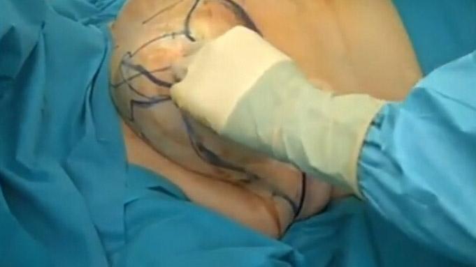 乳房縮小手術(shù)要多少錢？乳房縮小術(shù)是大手術(shù)嗎？
