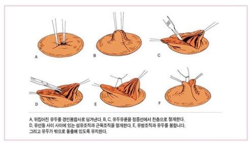 乳頭內(nèi)陷矯正手術(shù)多少錢？乳頭內(nèi)陷矯正手術(shù)多久可以恢復(fù)？