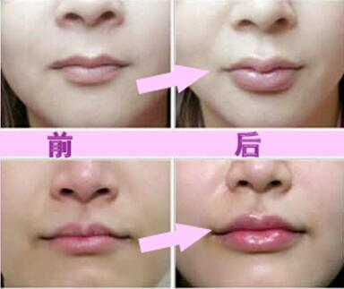 玻尿酸豐唇珠效果怎么樣？玻尿酸豐唇珠多少錢？