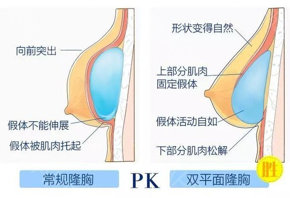 假體隆胸修復怎么做？做隆胸修復能維持多久？