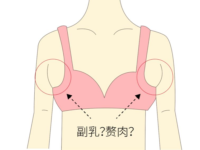 手術去副乳效果怎么樣？手術去副乳要注意什么？