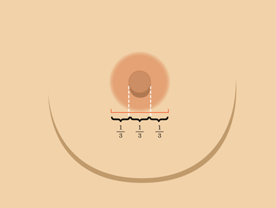 乳暈縮小如何矯正 乳暈縮小術(shù)的注意事項有哪些？