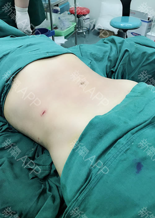 腰腹抽脂效果怎么樣？腰腹抽脂沒有瘦的原因？