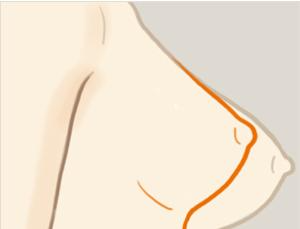 乳房下垂矯正手術(shù)風(fēng)險(xiǎn)有多大？ 乳房下垂矯正術(shù)多久能恢復(fù)？