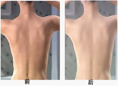 背部吸脂多久恢復(fù)？吸脂瘦背部注意事項(xiàng)
