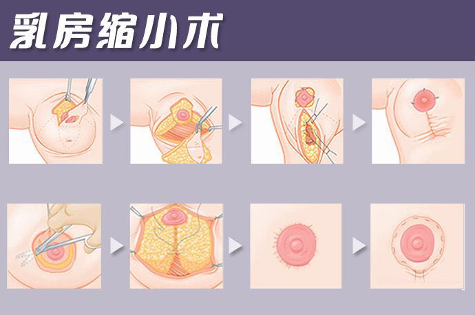 女性乳房縮小多少錢 ？女性乳房縮小住院幾天？