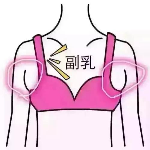吸脂做副乳要多少錢？吸脂去副乳會反彈嗎？