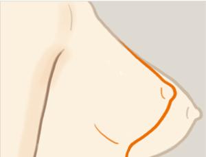 乳房下垂矯正手術(shù)風(fēng)險有多大？ 乳房下垂矯正術(shù)多久能恢復(fù)？