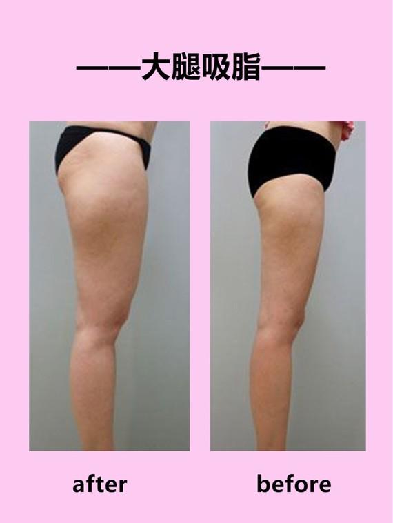 吸脂瘦大腿腫脹期是多久？大腿吸脂有什么后遺癥嗎？