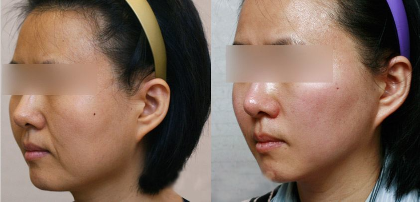 熱瑪吉做一次可以保持多久？熱瑪吉的原理和功效