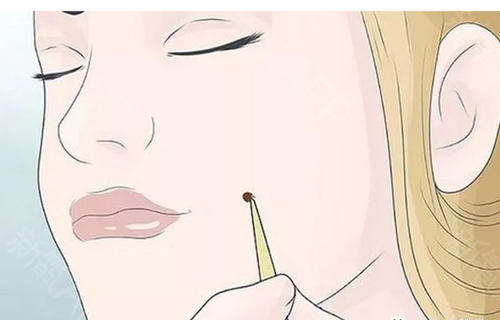 激光點痣要多久才會恢復？激光點痣多少錢？